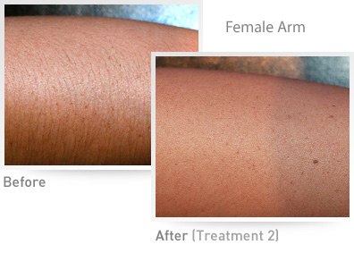 https://www.keiza.co/NARIAN/Hair_Removal_files/hr-rr-result4.jpg